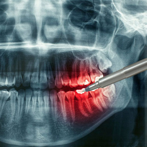 Dental computer tomography