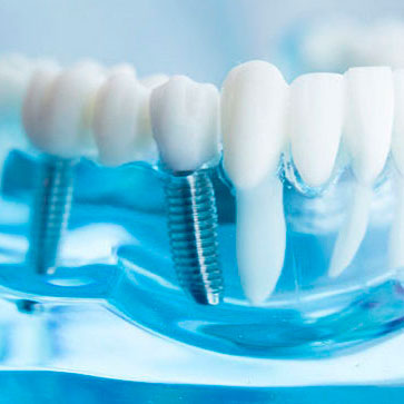Implantation