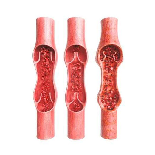 Varicosis therapy