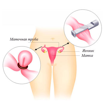 Laparoscopical sterilization