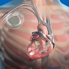 Implantation of an electric cardiac pacemaker