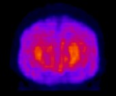 Radionuclide brain examination