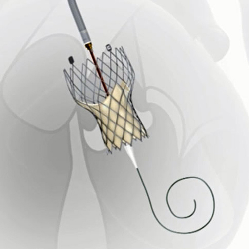 Transcatheteral implantation of aortic valve TAVR