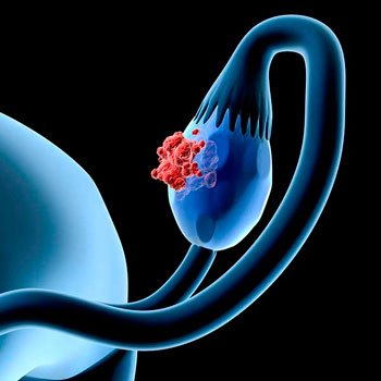 Gynecological oncology services