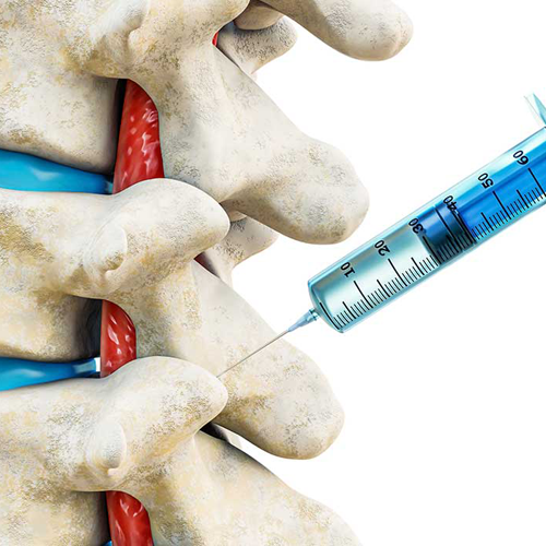 Interventional back pain treatment