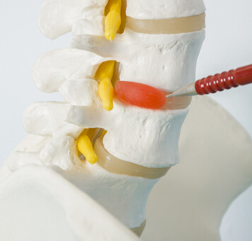 Minimally invasive treatment of spinal hernia