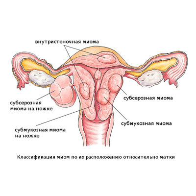 Uterine fibroid treatment