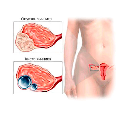 Surgical treatment of benign tumors