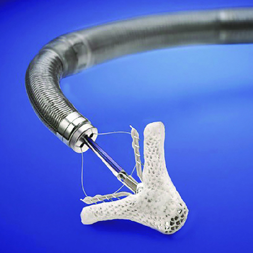 MitraClip implantation