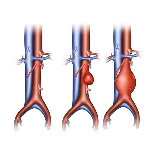 Aortography