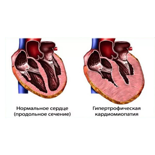 Surgical treatment of hypertrophic cardiomyopathy (HCM)