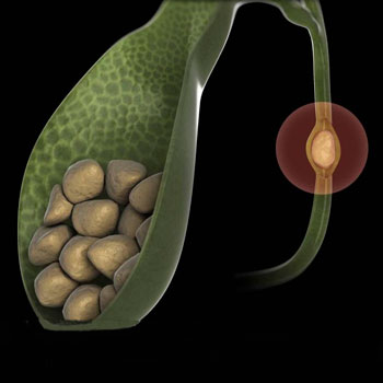 Surgical treatment of bile duct pathologies