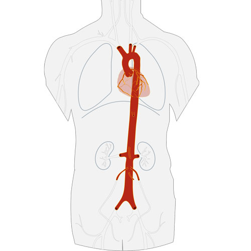 Thoraсtiс aorta surgery