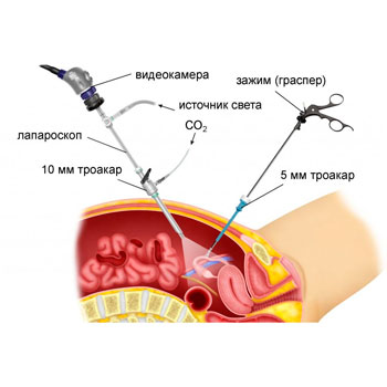 Surgical correction of uterine and vaginal development anomalities