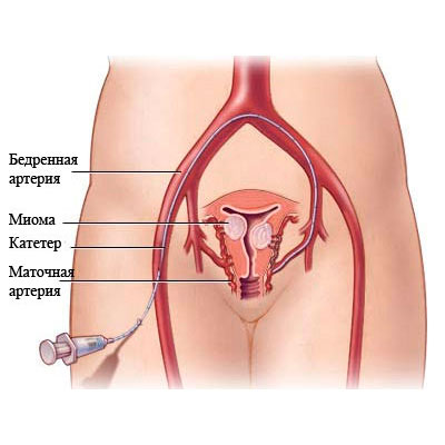 Uterine artery embolization