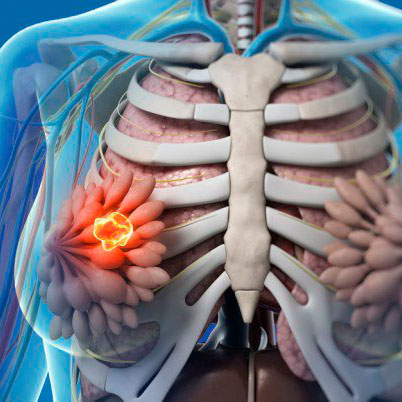 Mastopathy treatment