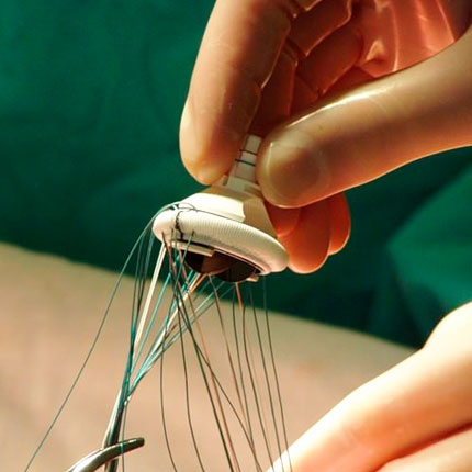 Heart valve surgery