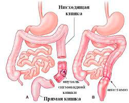 Удалении опухоли с участком кишки