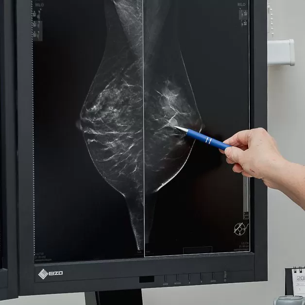 Mammography: why is it necessary after 50 and how does it differ from breast ultrasound?