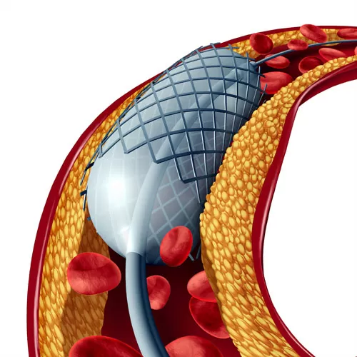 Angioplasty