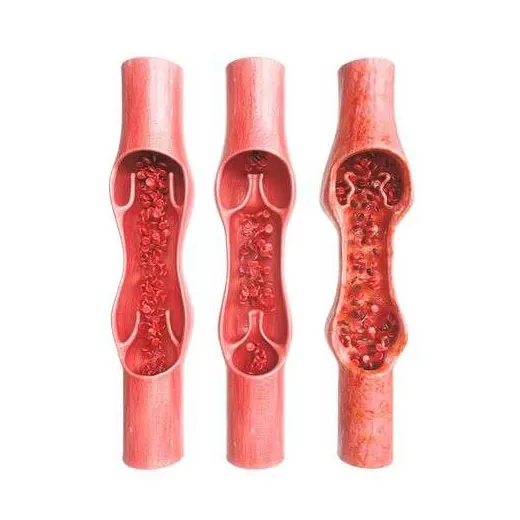 Varicosis therapy