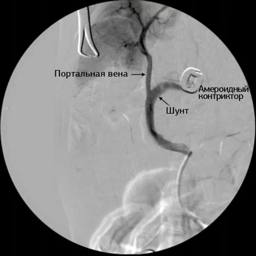 Arteriography