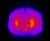 Radionuclide brain examination