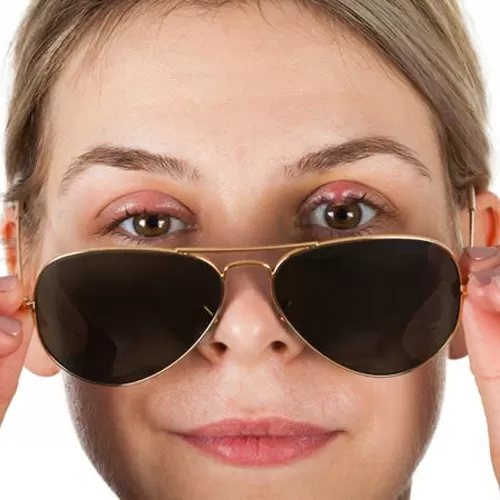 Surgical treatment of chalazion