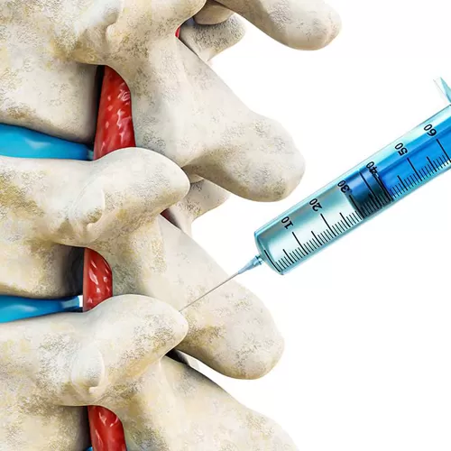 Modern interventing treatment of back pain to improve the quality of life of patients