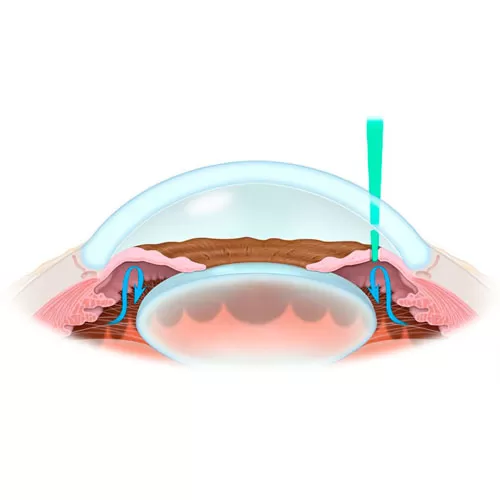 Surgical treatment of glaucoma