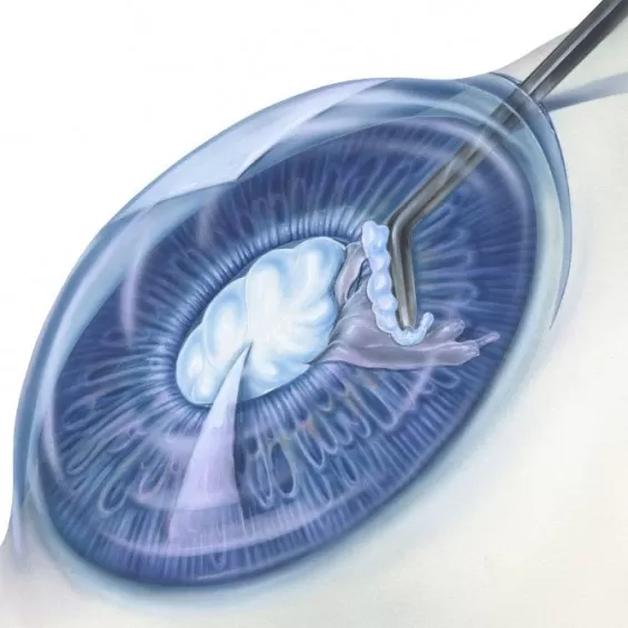 Surgical treatment of cataract