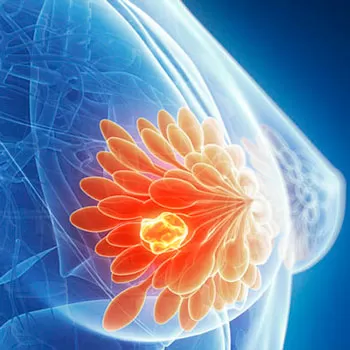 Breast oncology