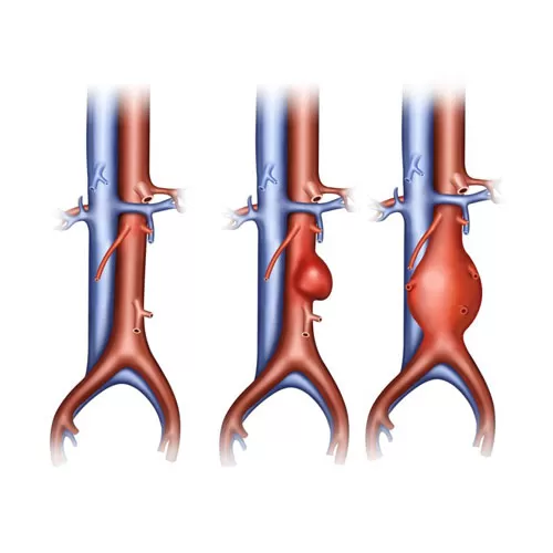Aortography