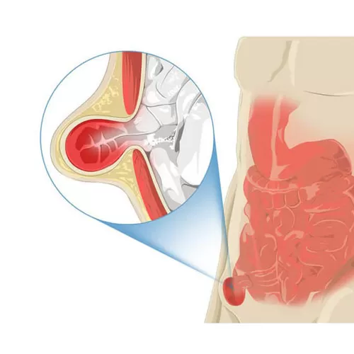 Surgical treatment of hernia