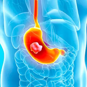 Surgical intervention of stomach deseases