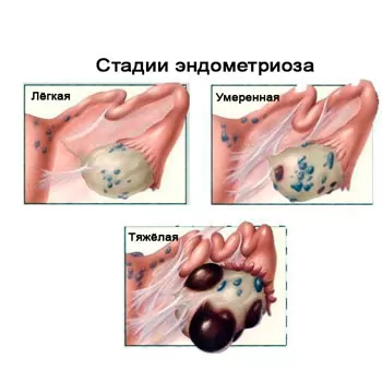 Surgical treatment of adenomyosis performed