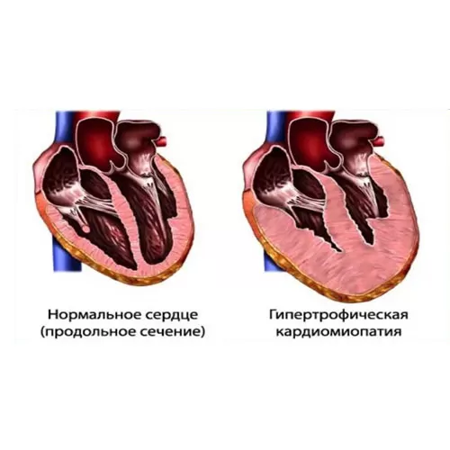 Surgical treatment of hypertrophic cardiomyopathy (HCM)