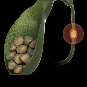 Surgical treatment of bile duct pathologies