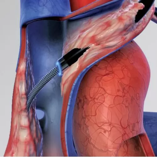 Extraction of electrodes