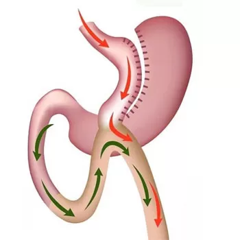 Methabolic surgery of type 2 diabetes