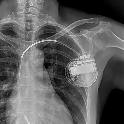 Implantation of an cardioverter