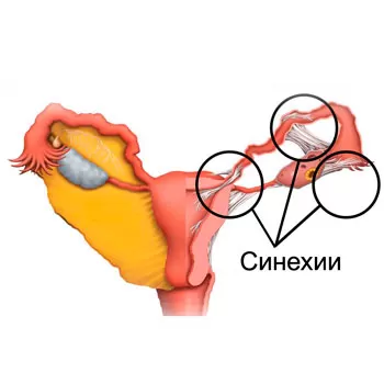 Surgical treatment of intrauterine pathologies