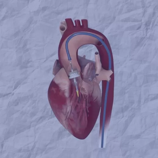 TAVI: when open heart surgery is contraindicated