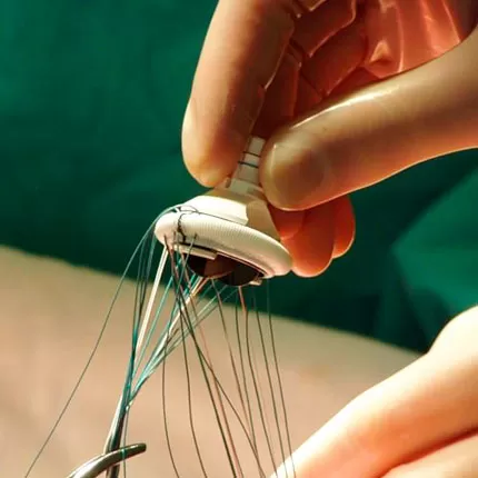 Heart valve surgery