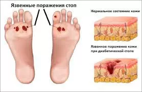 Диабетическая стопа