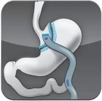 Mini-Gastric Bypass